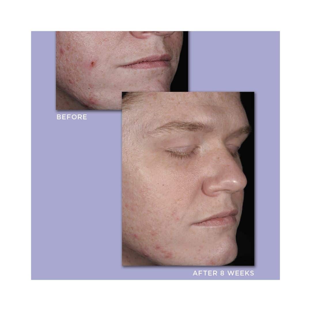 Comedone Acne Before and After