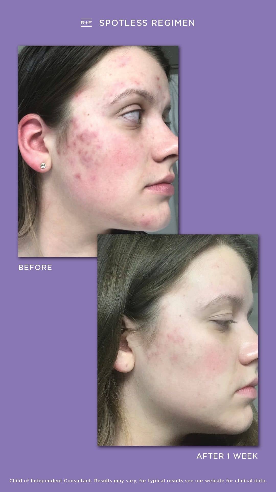 Spotless Acne Treatment