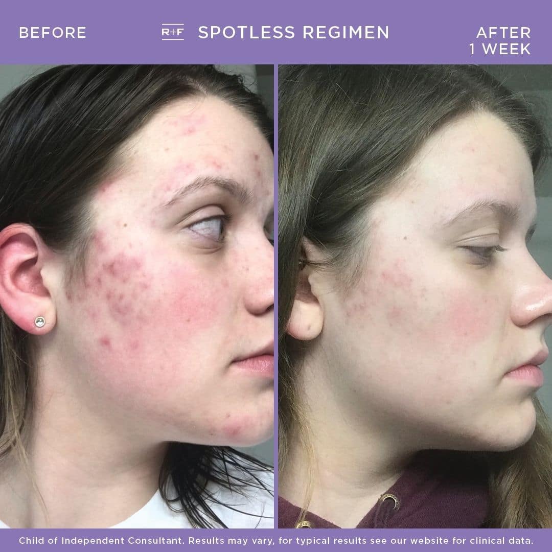 Teen Acne Face Mapping