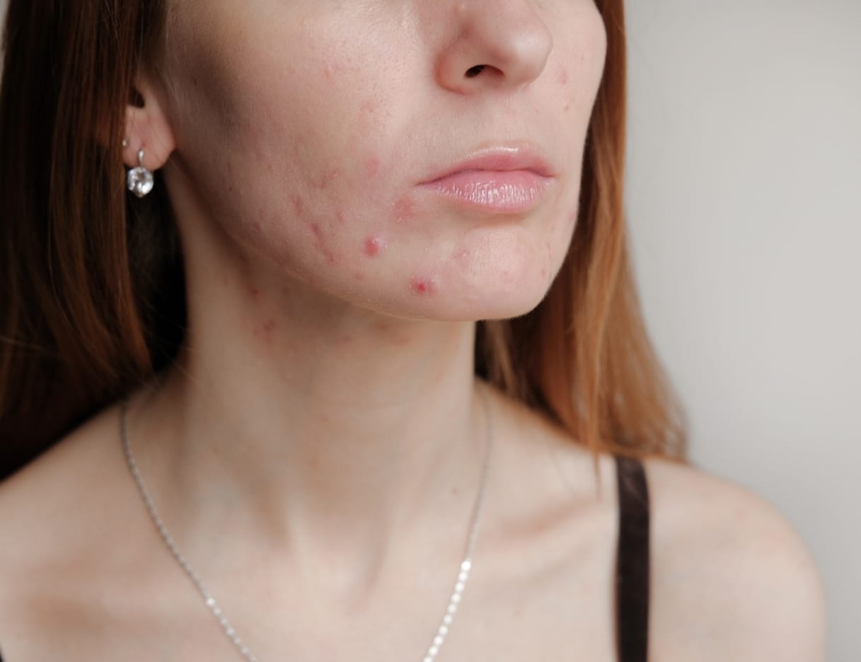 Acne + Maskne Rodan and Fields