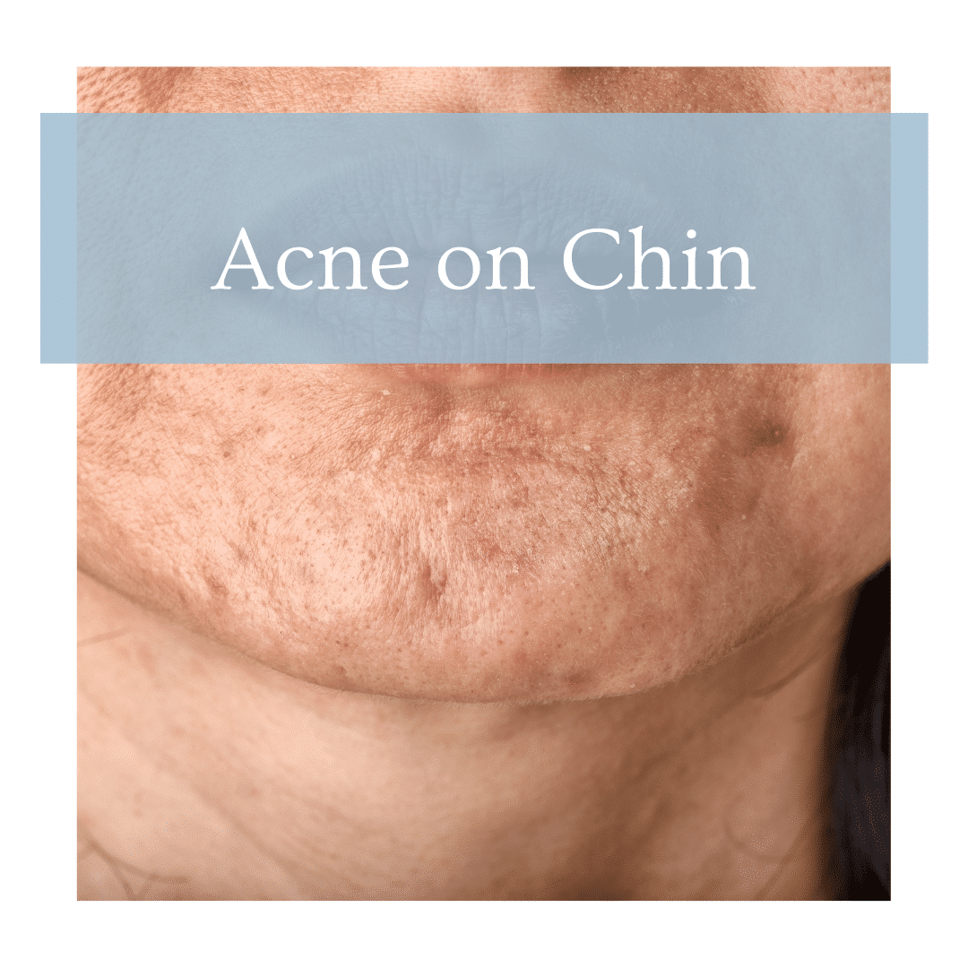 Acne on Chin - Acne Face Mapping