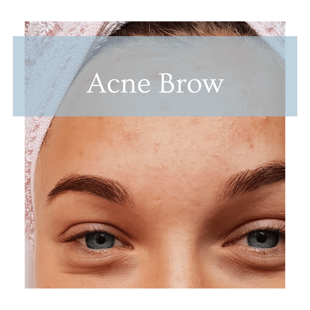 Acne on Brow