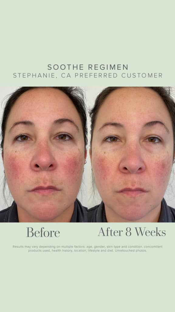 Sensitive Skin Skincare Before + Afters